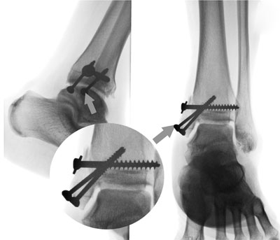 Postive Reversed X-Ray